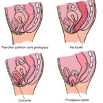 prolapsus génital