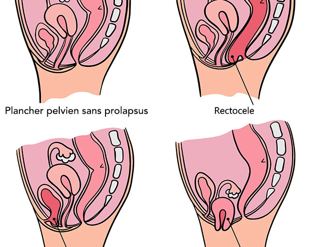 prolapsus génital